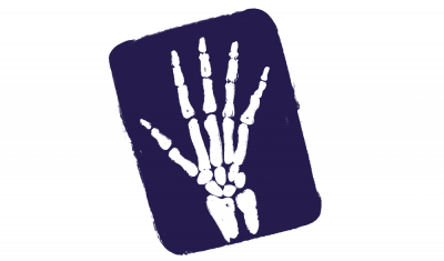 x-ray of hand