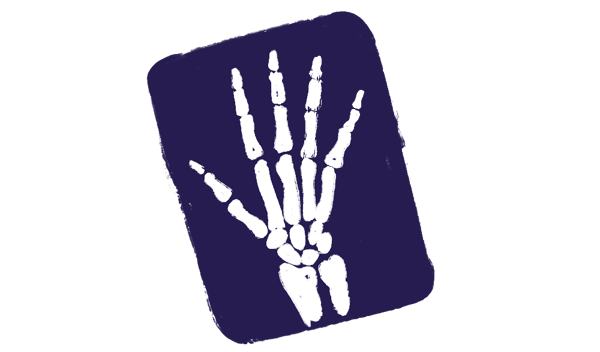 x-ray of hand